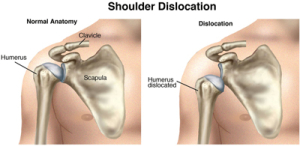 Dislocation - Shoulder