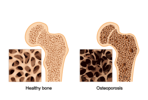fractures and bone density 2